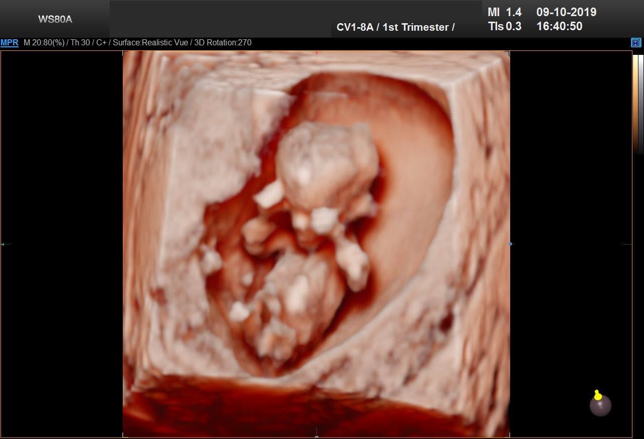 3D ultrazvuk – prvý trimester